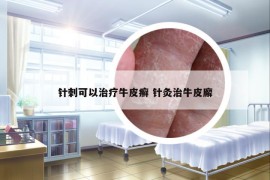 针刺可以治疗牛皮癣 针灸治牛皮廨