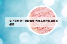 亲了之后会不会长癣呢 为什么亲过以后会长痘痘