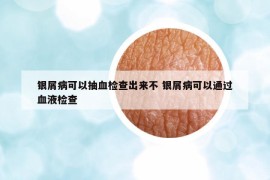 银屑病可以抽血检查出来不 银屑病可以通过血液检查