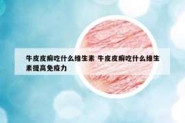 牛皮皮癣吃什么维生素 牛皮皮癣吃什么维生素提高免疫力