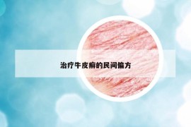 治疗牛皮癣的民间偏方