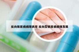 反向银屑病病理表现 反向型银屑病病情发展