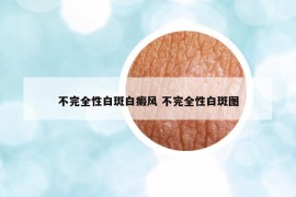 不完全性白斑白癜风 不完全性白斑图