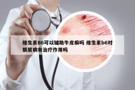 维生素B6可以辅助牛皮癣吗 维生素b6对银屑病有治疗作用吗