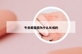 牛皮癣是因为什么长成的