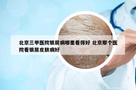 北京三甲医院银屑病哪里看得好 北京那个医院看银屑皮肤病好