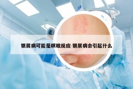 银屑病可能是瞑眩反应 银屑病会引起什么