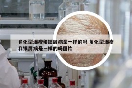 角化型湿疹和银屑病是一样的吗 角化型湿疹和银屑病是一样的吗图片