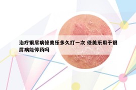 治疗银屑病修美乐多久打一次 修美乐用于银屑病能停药吗