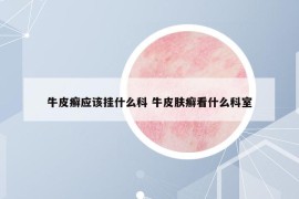 牛皮癣应该挂什么科 牛皮肤癣看什么科室