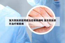 复方氨肽素能彻底治愈银屑病吗 复方氨肽素片治疗银屑病