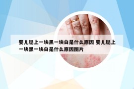 婴儿腿上一块黑一块白是什么原因 婴儿腿上一块黑一块白是什么原因图片