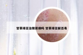 甘草绿豆治银屑病吗 甘草绿豆解百毒