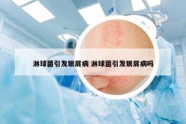 淋球菌引发银屑病 淋球菌引发银屑病吗