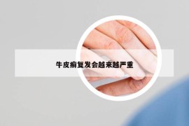 牛皮癣复发会越来越严重