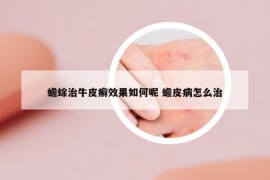 蟾蜍治牛皮癣效果如何呢 蟾皮病怎么治