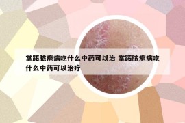 掌跖脓疱病吃什么中药可以治 掌跖脓疱病吃什么中药可以治疗