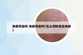 体癣传染吗 体癣传染吗?怎么预防感染体癣?