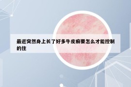 最近突然身上长了好多牛皮癣要怎么才能控制的住