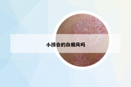 小孩会的白癜风吗