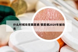 什么时候攻克银屑病 银屑病2020年被攻克