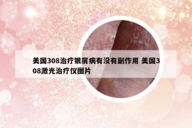 美国308治疗银屑病有没有副作用 美国308激光治疗仪图片