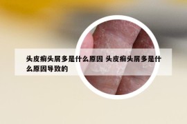 头皮癣头屑多是什么原因 头皮癣头屑多是什么原因导致的