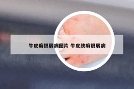 牛皮癣银屑病图片 牛皮肤癣银屑病