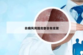 白癜风周围皮都会有皮屑