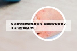 深圳哪家医院看牛皮癣好 深圳哪家医院有心理治疗医生最好的