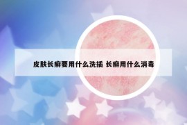 皮肤长癣要用什么洗插 长癣用什么消毒