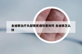 金迪银治疗头部银屑病效果如何 金迪银怎么样