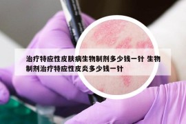 治疗特应性皮肤病生物制剂多少钱一针 生物制剂治疗特应性皮炎多少钱一针