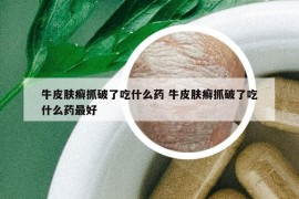 牛皮肤癣抓破了吃什么药 牛皮肤癣抓破了吃什么药最好