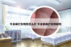 牛皮癣打生物剂怎么打 牛皮肤癣打生物制剂