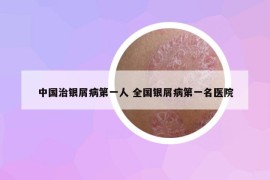 中国治银屑病第一人 全国银屑病第一名医院