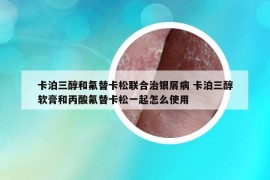 卡泊三醇和氟替卡松联合治银屑病 卡泊三醇软膏和丙酸氟替卡松一起怎么使用