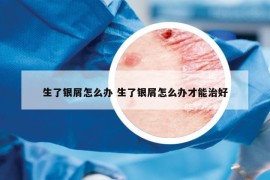 生了银屑怎么办 生了银屑怎么办才能治好