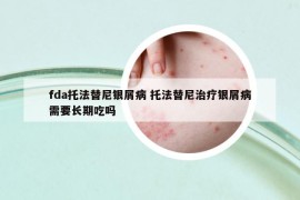 fda托法替尼银屑病 托法替尼治疗银屑病需要长期吃吗