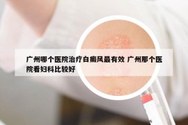 广州哪个医院治疗白癜风最有效 广州那个医院看妇科比较好