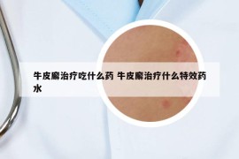 牛皮廨治疗吃什么药 牛皮廨治疗什么特效药水