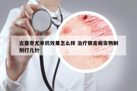 古塞奇尤单抗效果怎么样 治疗银皮癣生物制剂打几针