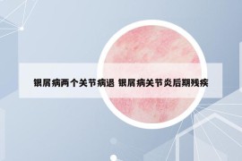 银屑病两个关节病退 银屑病关节炎后期残疾