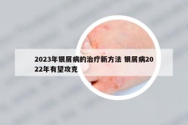 2023年银屑病的治疗新方法 银屑病2022年有望攻克