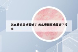 怎么看银屑病要好了 怎么看银屑病要好了没有