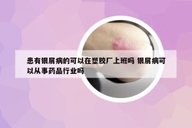 患有银屑病的可以在塑胶厂上班吗 银屑病可以从事药品行业吗