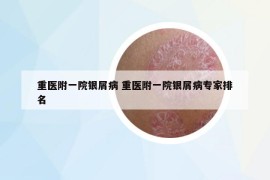 重医附一院银屑病 重医附一院银屑病专家排名