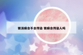 银消癣会不会传染 银癣会传染人吗