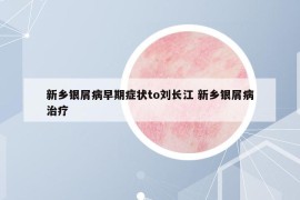 新乡银屑病早期症状to刘长江 新乡银屑病治疗