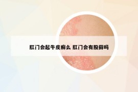 肛门会起牛皮癣么 肛门会有股藓吗